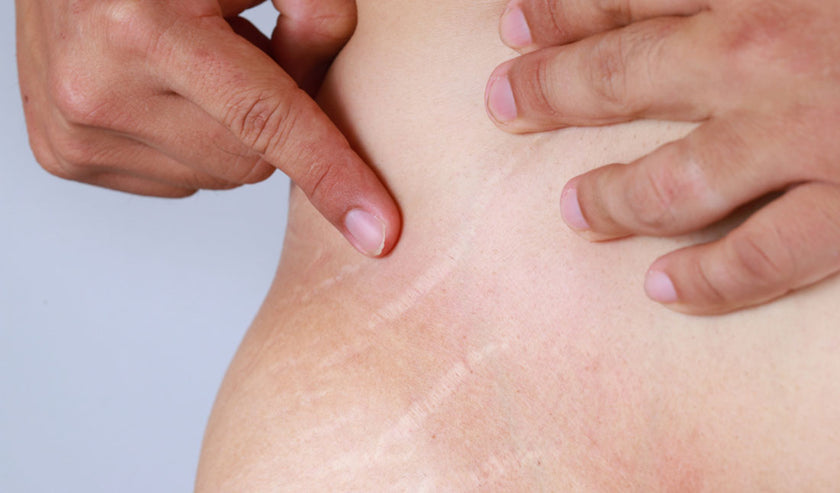 belly stretch marks belly stretch marks